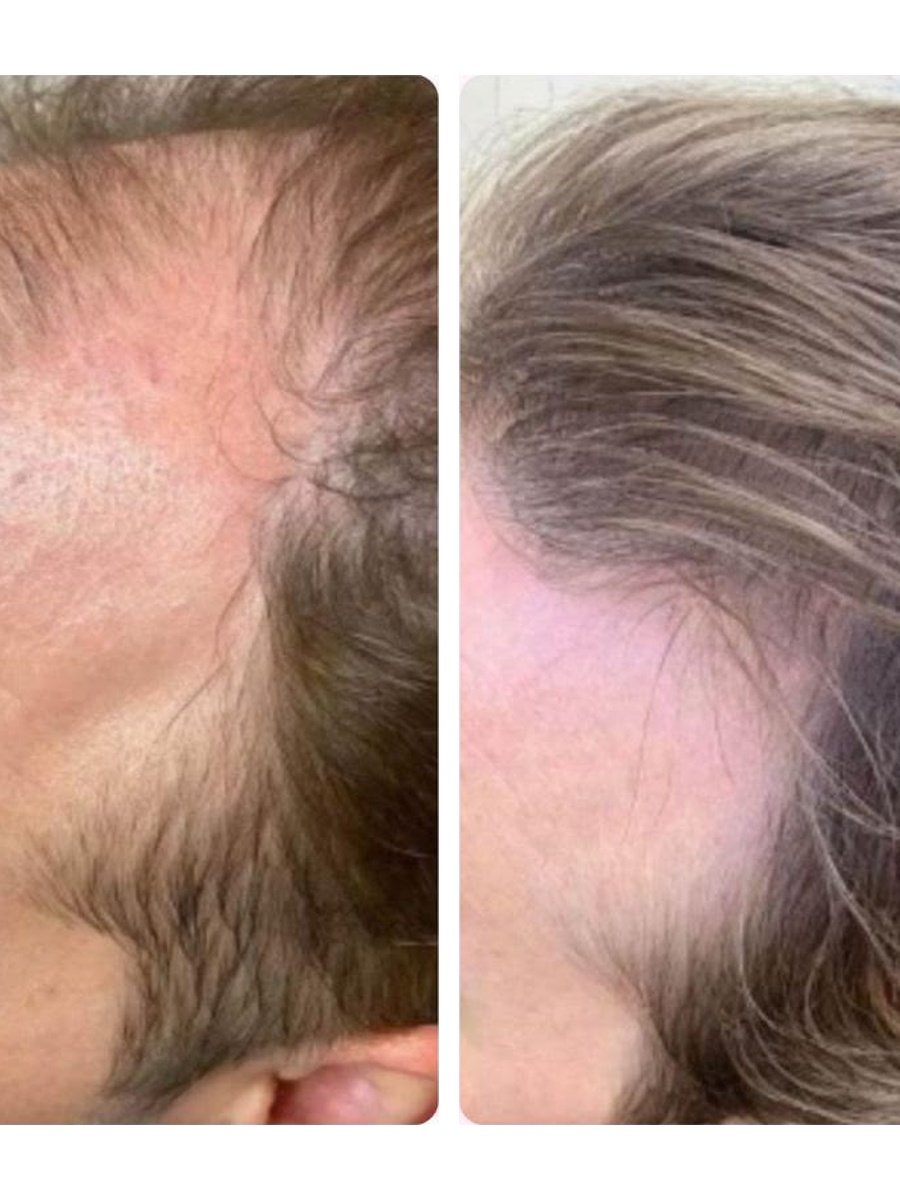 Before and after Follicle Boost hair treatment